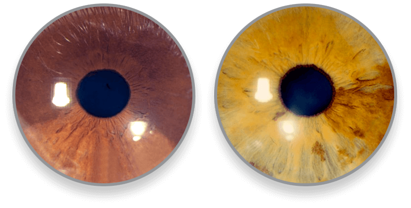 iris-galeria2-luis-fernando-mejia-oftalmologo