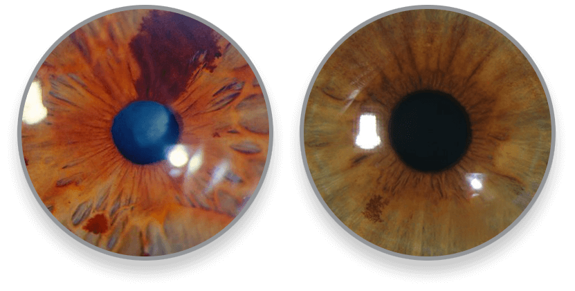 iris-galeria3-luis-fernando-mejia-oftalmologo